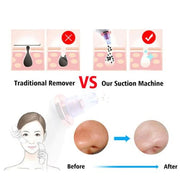 Blackhead Suction Tool – Clear Skin with Deep Cleaning Power